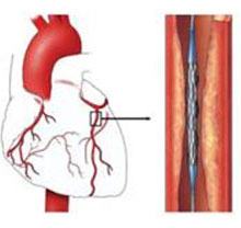 Does Metal Have Memory? Nitinol - A Nickel Titanium Alloy